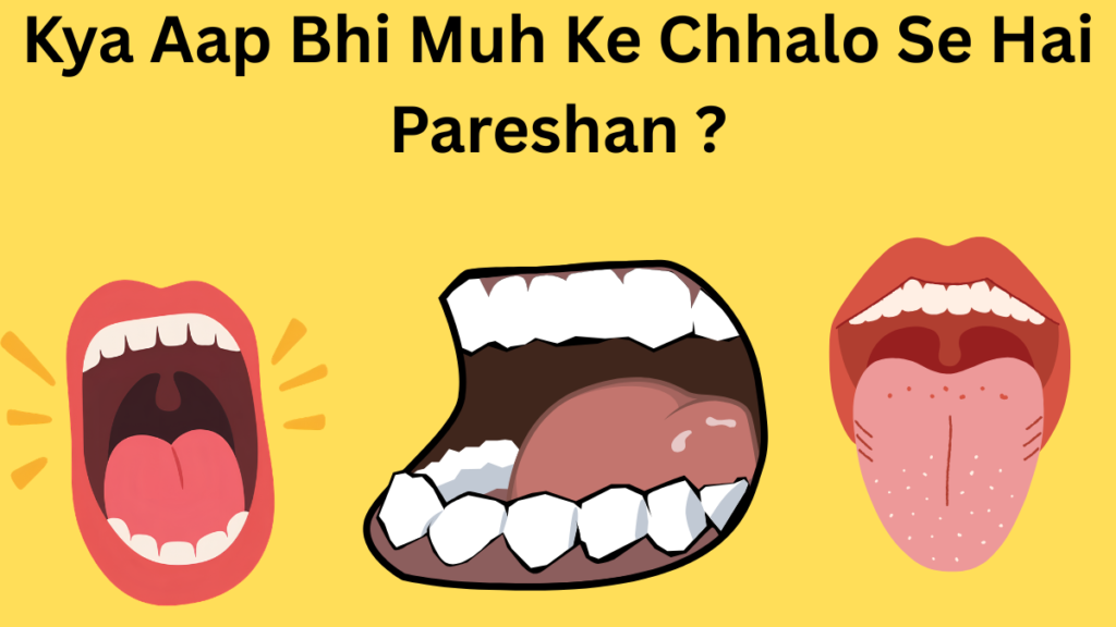 Kya Aapko Bhi Muh Mein Baar Baar Chhale Hote Hai Hain?Janiye Ishke Karan